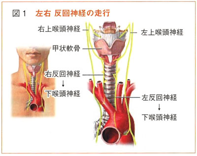 声帯麻痺