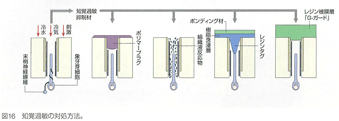 知覚過敏