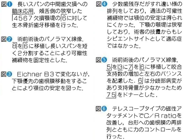 自家移植とインプラント