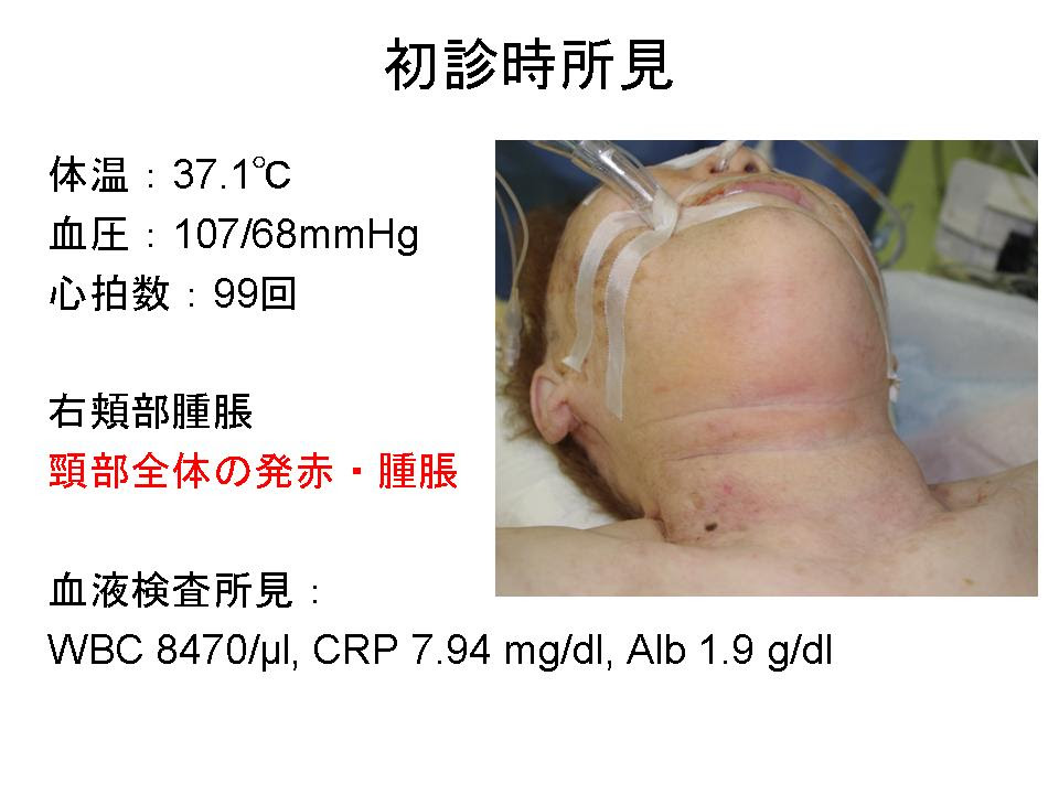 頸部感染症疑いは全例CTを